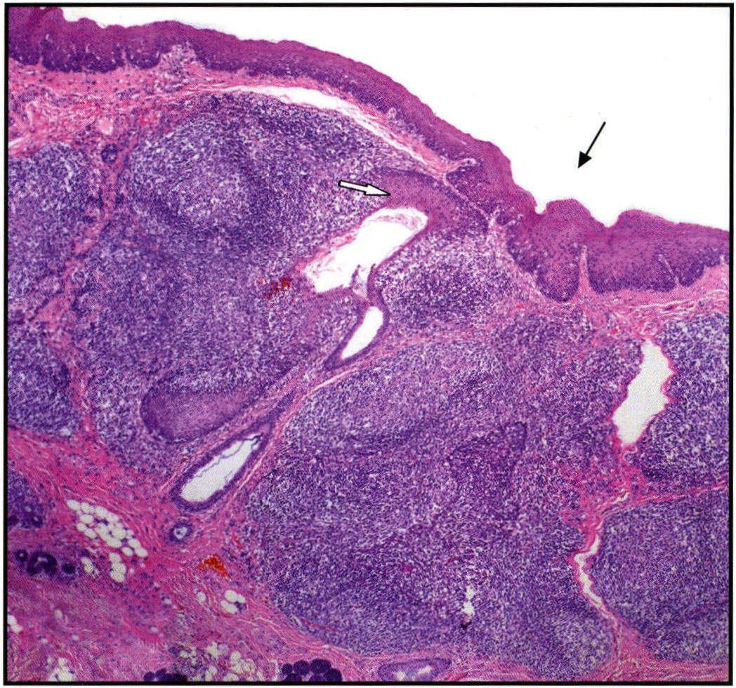 浸润性尿路上皮癌，巢状型
